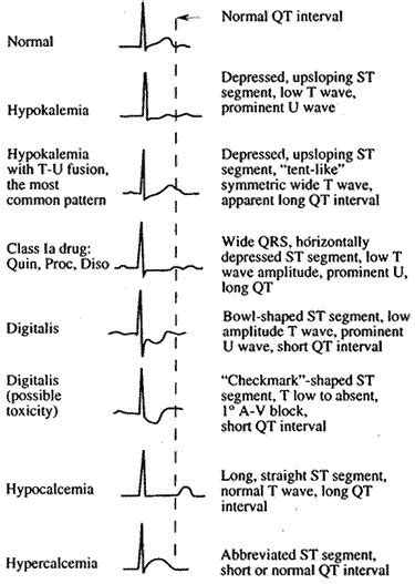 Hypomagnesemia EKG | Various morphologies of ST-T-U abnormalities, as ...