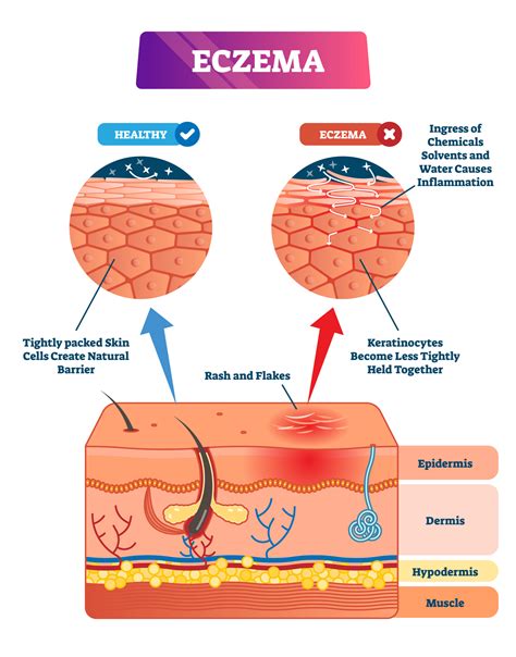 What are the Best Carrier Oils for Eczema: A Comprehensive Guide