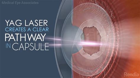 YAG Laser creates a clear pathway in capsule - Medical Eye Associates