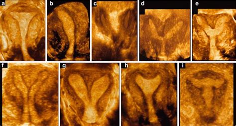 Congenital Uterine Anomalies | Radiology Key