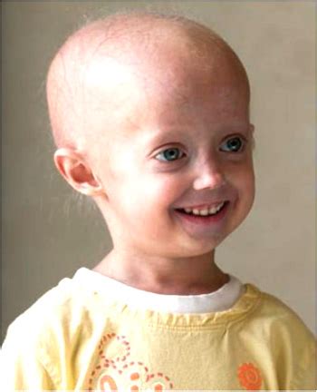 Fajarv: Progeria Genetic Disorder