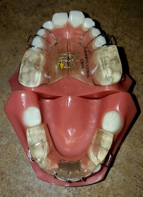 19 Orthodontics Appliances ideas | orthodontics, dental, appliances