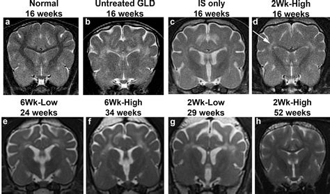 Progress toward a treatment for Krabbe disease