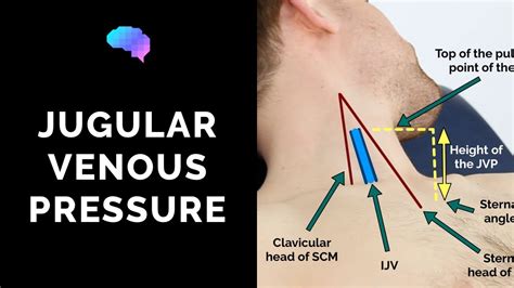 Measuring Jugular Venous Pressure (JVP) - OSCE Guide (Clip) | UKMLA | CPSA - YouTube