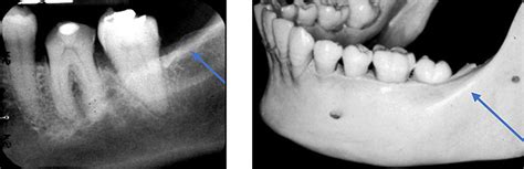 Submandibular Fossa Radiograph