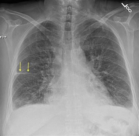 Here are some examples of " fluid in the fissure