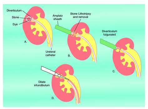 Percutaneous management of stones within calyceal diverticula including ...