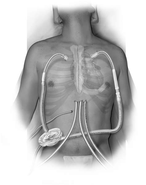 Novel Cannulation Technique for Temporary Right Ventricular Assist ...