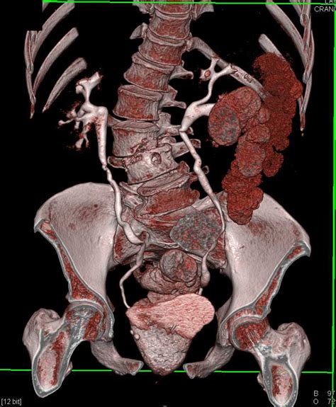 Osteomyelitis L-Spine as well as Acute Pyelonephritis - Musculoskeletal Case Studies - CTisus CT ...