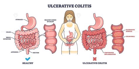 Ulcerative colitis as chronic inflammatory bowel disease outline diagram - VectorMine