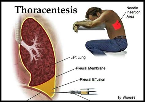 pleural effusion biopsy