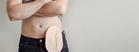 What is the Difference Between an Ostomy and a Colostomy?