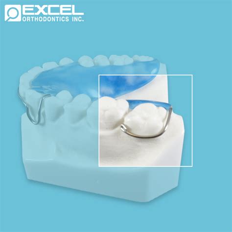 Clasp Options - Excel Orthodontics