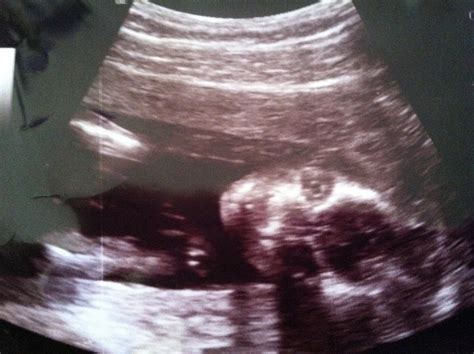 We're Having a Baby!: 18 Week Ultrasound Pictures