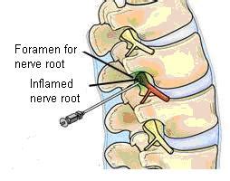 Nerve Root Injection - Joint Reaction