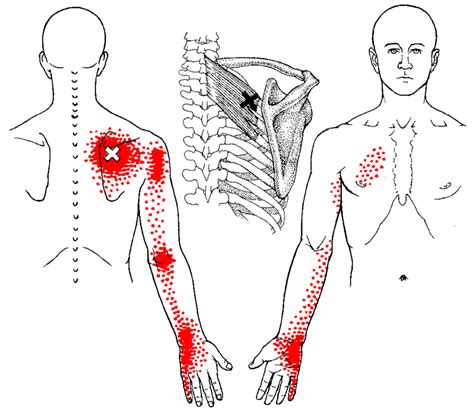 Myofascial Trigger Point Therapy | PalmLeaf Massage Clinic — Buffalo ...