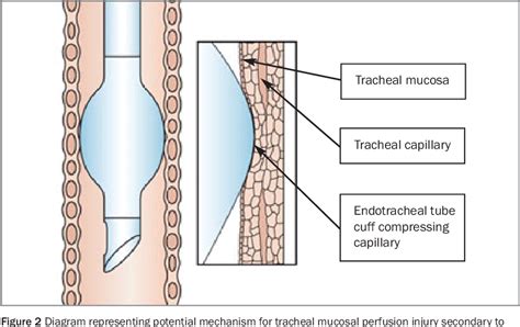 Endotracheal Tube Cuff Pressure Monitoring: A Review of the Evidence | Semantic Scholar