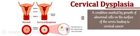 Cervical Dysplasia - Causes, Symptoms, Diagnosis, Treatment & Prevention