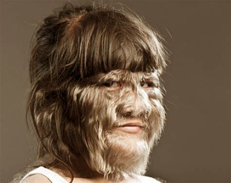 👉 Hypertrichosis - Symptoms, Causes, Treatment, Pictures (December 2021)