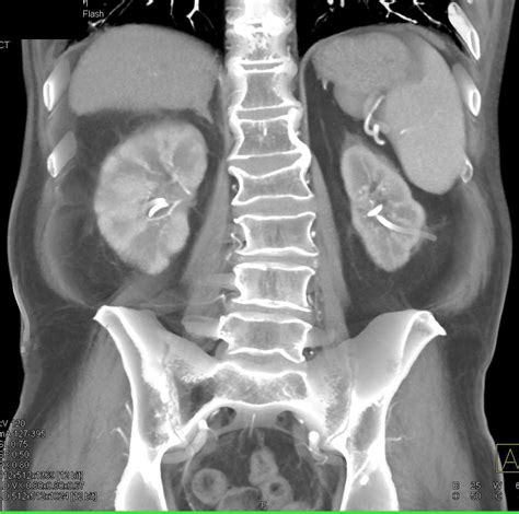 Striated Nephrograms and Acute Pyelonephritis Right Kidney - Kidney Case Studies - CTisus CT ...