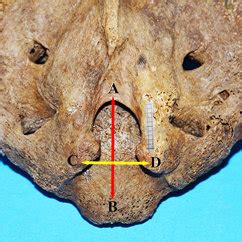 Anatomy of the sacral hiatus and its clinical relevance in caudal epidural block | Request PDF