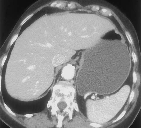 Current Role of CT in Imaging of the Stomach | RadioGraphics