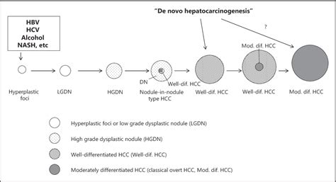 Figure 1 from Early Hepatocellular Carcinoma: Definition and Diagnosis ...