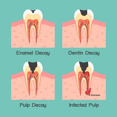 Toothache Emergencies | Emergency Dentist Allen | Paragon Dentistry