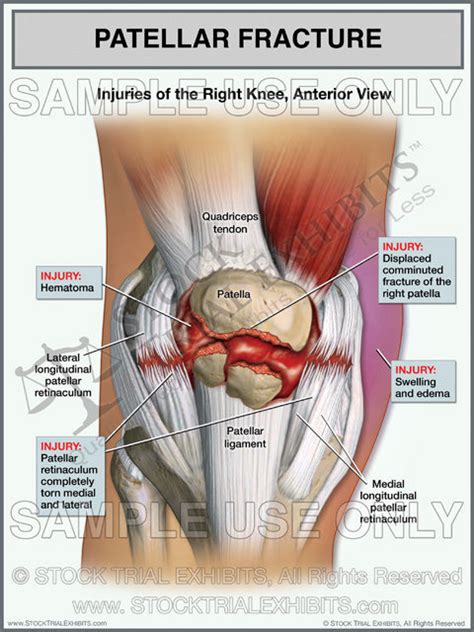 Patellar Fracture of the Right Knee with Torn Retinaculum – Stock Trial Exhibits