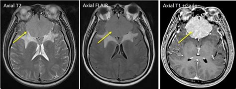 Olfactory groove meningioma – Radiology Cases