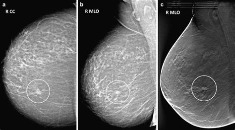 Breast tomosynthesis and digital mammography: a comparison of breast cancer visibility and ...