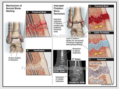 Bone Remodeling: Fracture Healing Process and Associated Complications ...