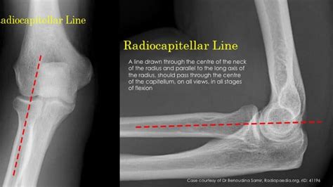 Elbow Fractures | Emergency Medicine Education | Resus