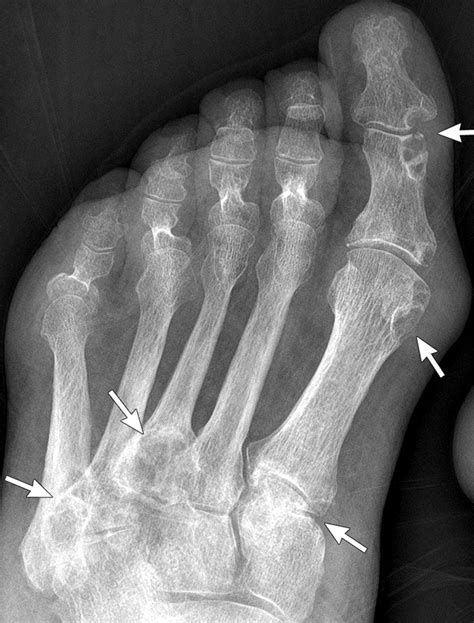 Gout. Anteroposterior foot radiograph shows multiple punched-out sclerotic erosions (arrows ...