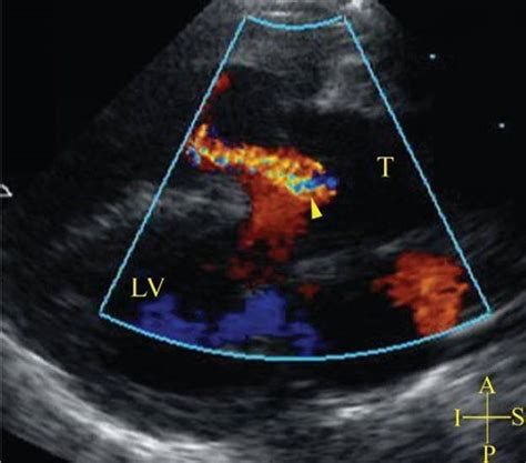 Truncus Arteriosus - Echocardiography in Pediatric and Adult Congenital Heart Disease, 2nd Ed.