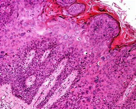 Erythroplasia Of Queyrat