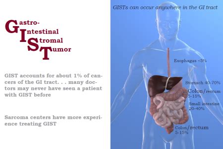 Understanding GIST - What Are Gastrointestinal Stromal Tumors? | The ...