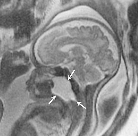 A large neck teratoma in a 21-week fetus. a Coronal T2-W MR image shows... | Download Scientific ...