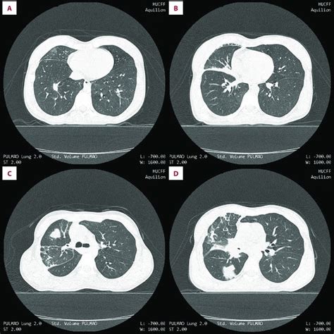 CT scan of the chest with a lung window showing a spiculated 15×11 mm... | Download Scientific ...