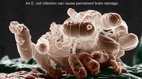 E. coli Seizures from HUS, TTP, or Sepsis | Lawyers for Lawsuit Settlement