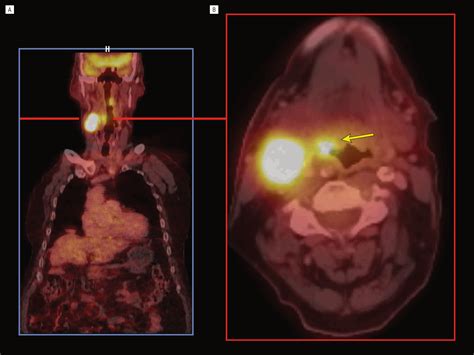 Neck Dissection: An Operation in Evolution | Oncology | JAMA ...