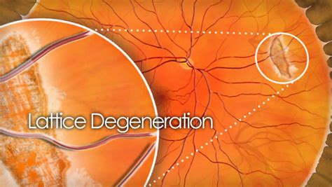 Lattice degeneration of retina causes, symptoms, diagnosis, prognosis & treatment