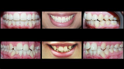 Invisalign for Treating Crowding Teeth and Crossbite at Cosmetic Dental Associates - YouTube