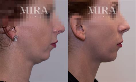 Progress Report On Double Chin Dissolving Injections - MIRA Clinic