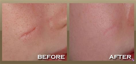 Sebaceous Cyst Removal Scar