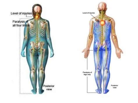 paraplegia causes Archives - SAMARPAN PHYSIOTHERAPY CLINIC AHMEDABAD