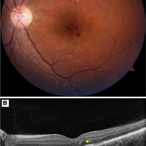 Fundus images of the patient. (A) Normal right eye fundus. (B) Left eye... | Download Scientific ...