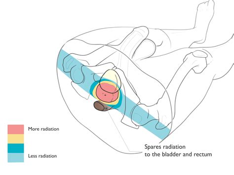 Proton Beam Therapy Prostate Side Effects - The Best Picture Of Beam