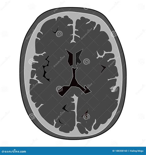 Illustrative Picture of Normal Ct Scan of Head of Human Brain. Stock Photo - Image of radiation ...