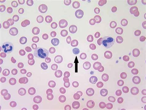 Platelets: Overview, Morphology, Quantity, Platelet Function Disorders (Thrombocytopathia or ...